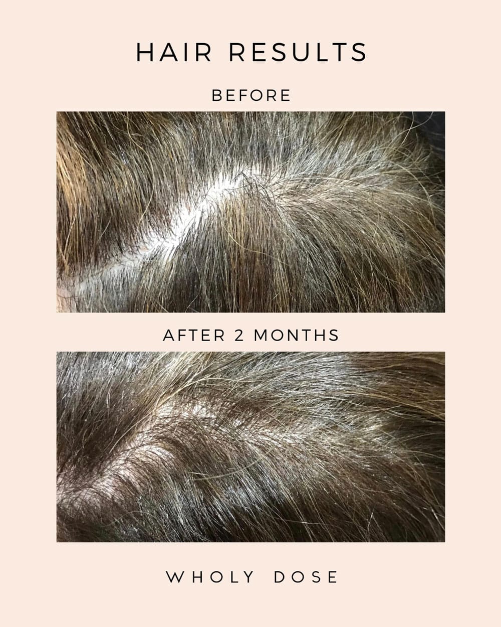 Wholy Dose Supplement Mix Collagen Unflavored Hair results, showing a before and after two months pictures of the part in someone's hair with noticably improved hair growth