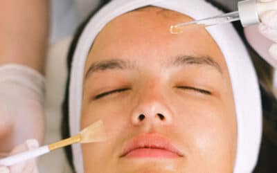 8 Reasons You Should Have A Chemical Peel